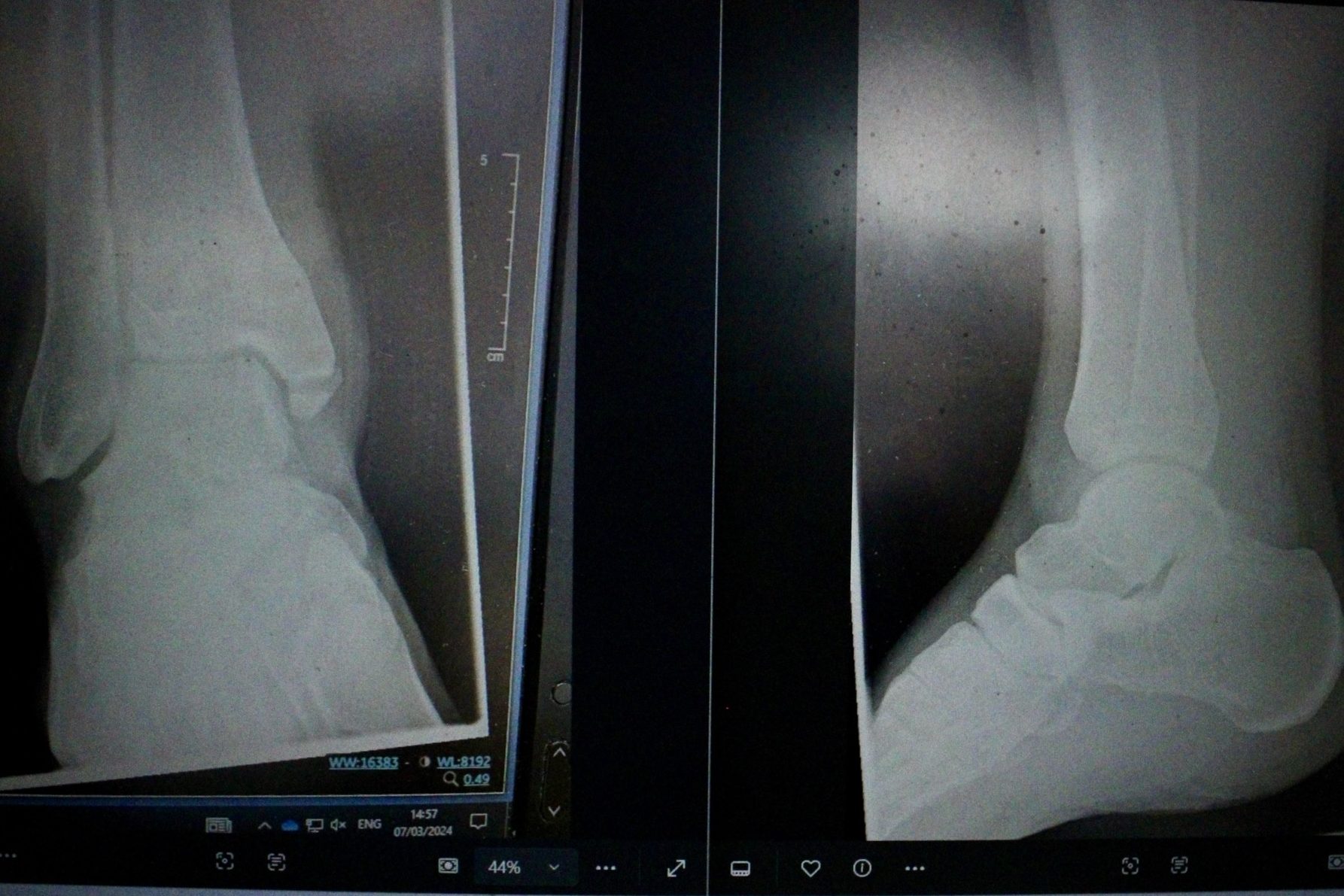 Kieran's x-ray of his broken ankle.